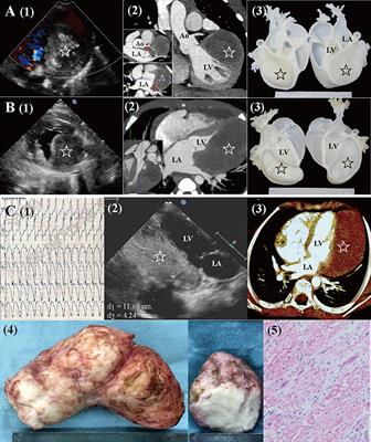 Surgery for Primary Cardiac Tumors in Children: Successful Management of Large Fibromas